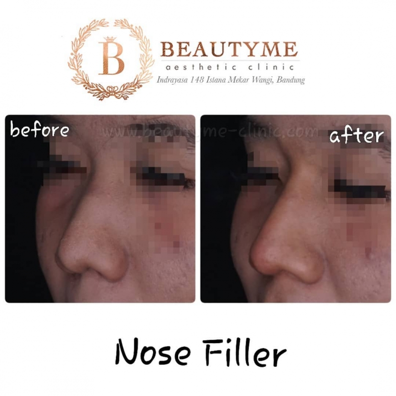 Nose Filler / Filler Hidung