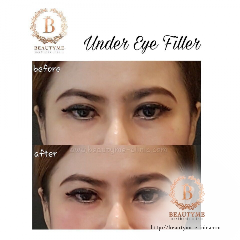 Eye Filler / Under Eye Filler