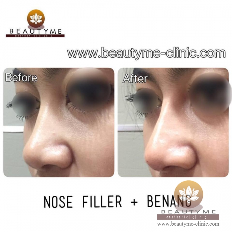 Nose Filler / Filler Hidung