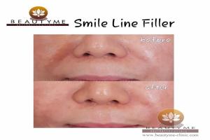 Smile Line Filler
