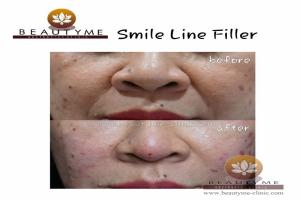 Smile Line Filler