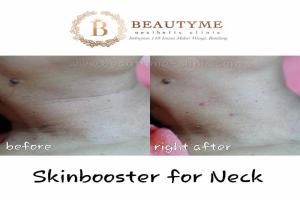 Skinbooster For Neck / Leher