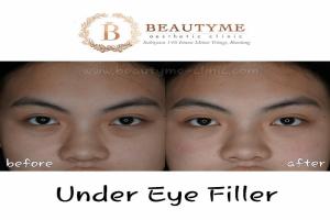 Eye Filler / Under Eye Filler