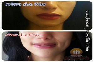 Chin Filler / Filler Dagu