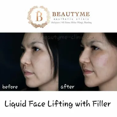 gallery img: Liquid Face Lifting With Filler