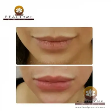 gallery img: Filler Bibir Sexy / Lip Filler