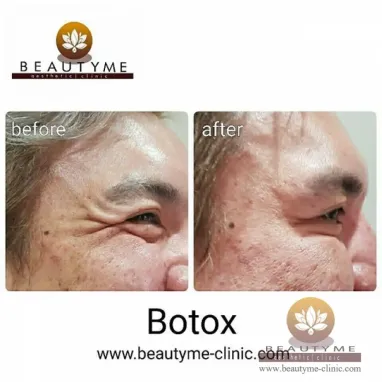 gallery img: Botox