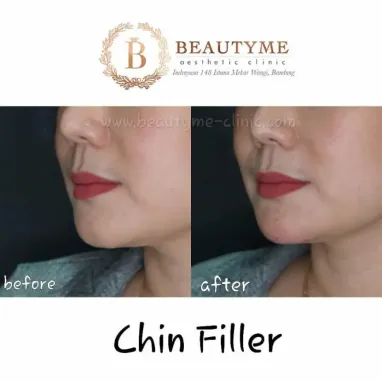 gallery img: Chin Filler / Filler Dagu