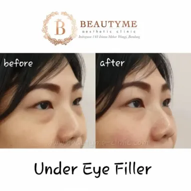 gallery img: Eye Filler / Under Eye Filler
