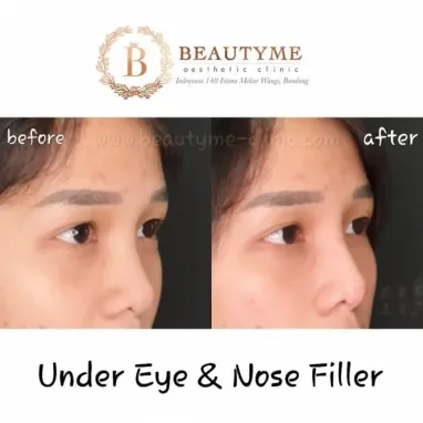 gallery img: Eye Filler / Under Eye Filler