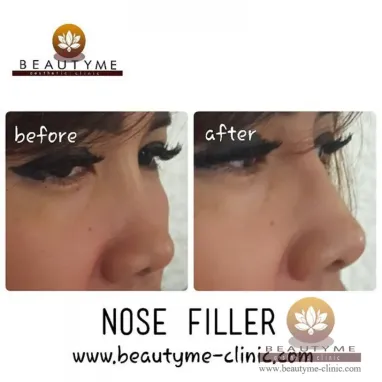 gallery img: Nose Filler / Filler Hidung