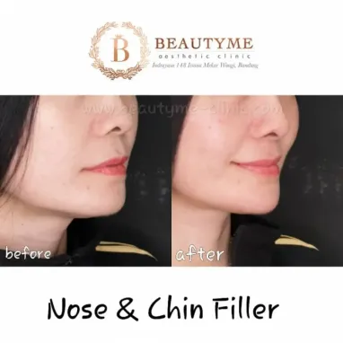 gallery img: Nose Filler / Filler Hidung
