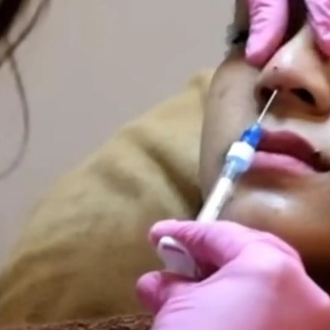 Pemancungan Hidung Tanpa Operasi 