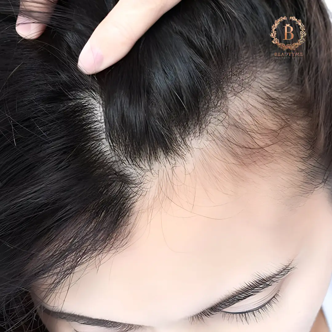 Mengapa Kamu Butuh Kombinasi Hair Growth Treatment dan Booster?