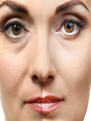 Collagen Filler, Apakah Bermanfaat Mengatasi Keriput?