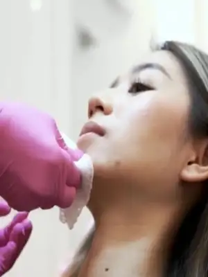 Menghilangkan Keriput Garis Senyum di Wajah