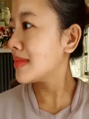 After Treatment Filler Hidung